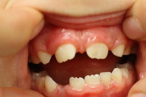 Выраженная диастема между несколькими зубами