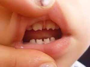 Аномалии зубов на фоне врожденного сифилиса