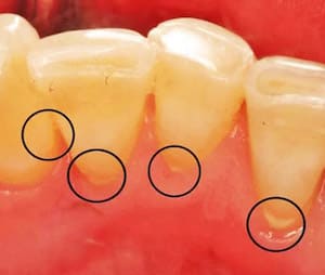 Симптомы зубного камня
