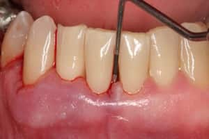 Пародонтит - воспаление тканей вокруг зуба и его корня