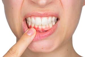 Пародонтоз - невоспалительное поражение тканей, окружающих зуб