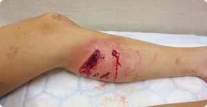 Рваная рана после укуса собаки