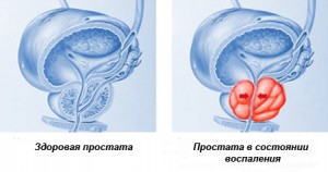Механизм развития хронического простатита