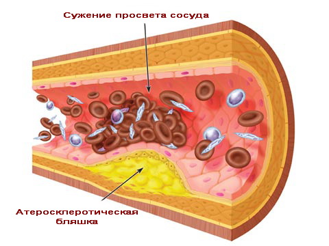 Атеросклероз - причина сужения артерий